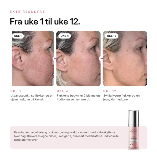Anti-Pigment Dual Serum, ekte resultat, brukerens egne bilder